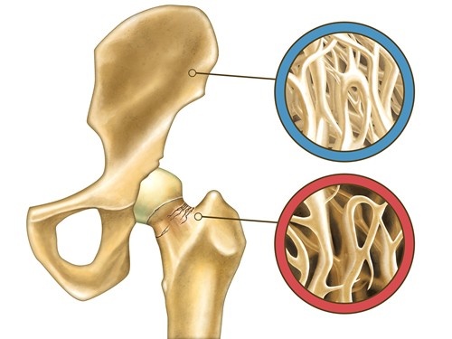 Osteoporose Knochen porös Knochenbruch Vitamin K K2 Osteopathie